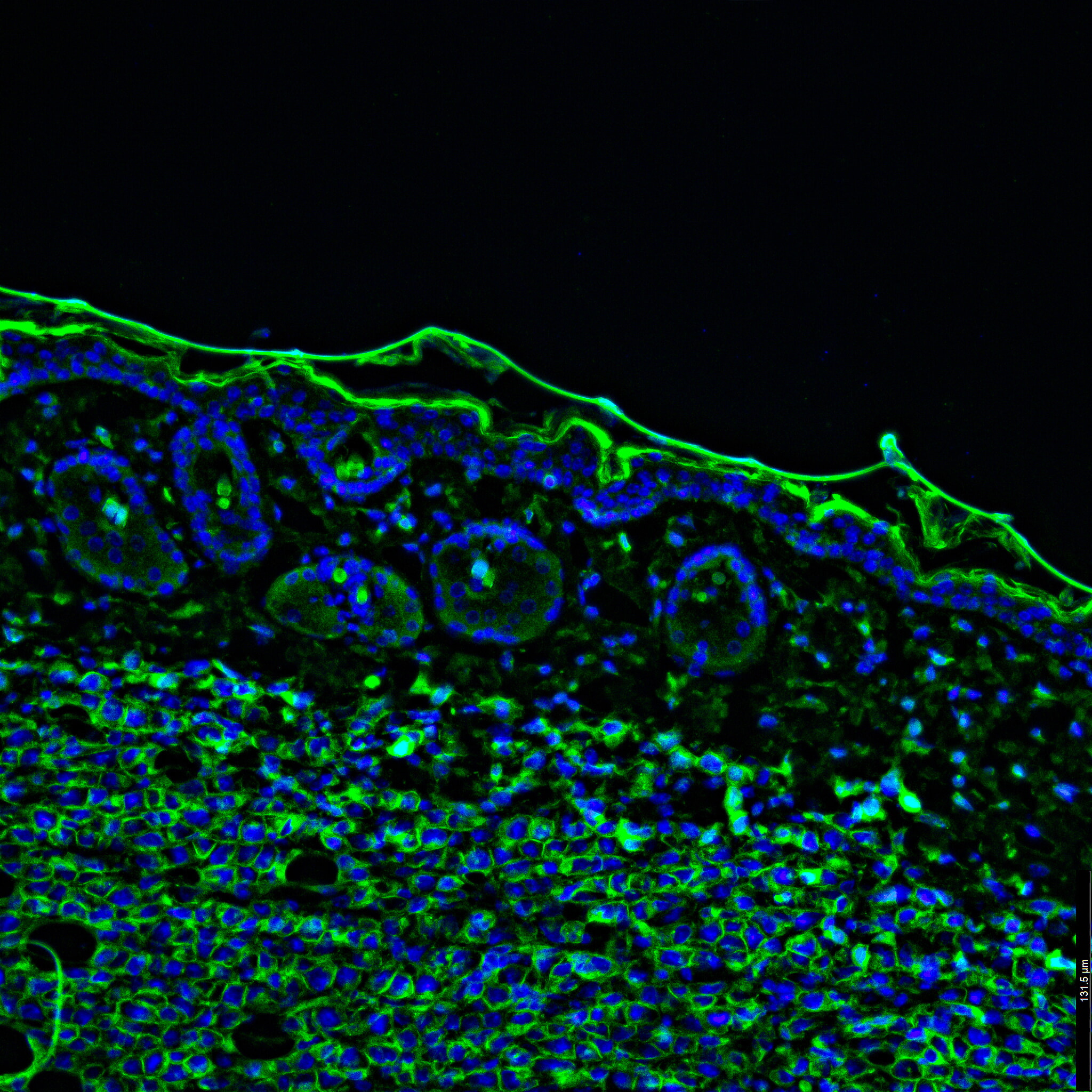 Tumour Immunofluorescence IHC Image. Aggressive Metastatic Melanoma Tumor Cells In Green With Blue Nuclei Invading Into The Skin.
