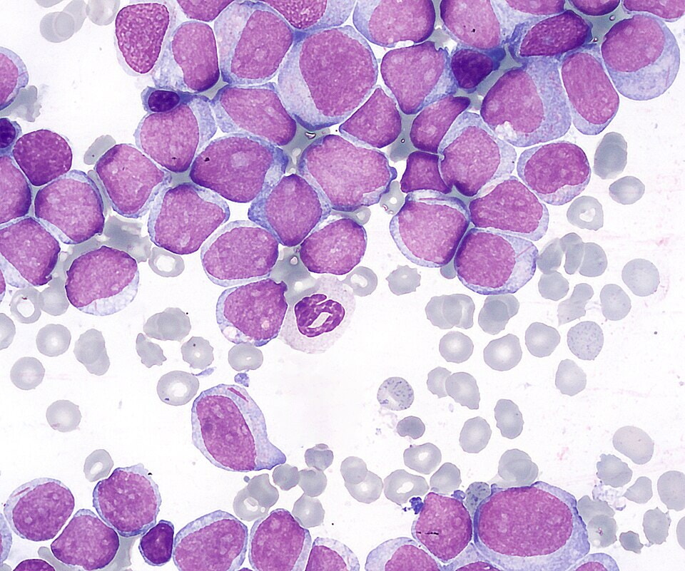 960px Acute Myeloid Leukemia (M2 Type)