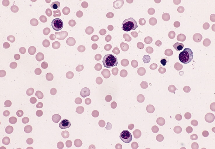 AML M6, Blood Smear